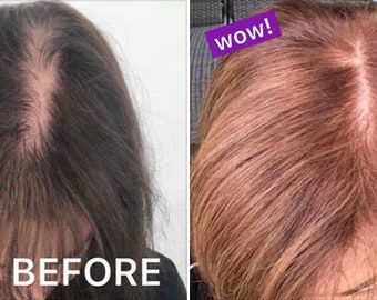 Ayurvedic Hair and scalp oil treatment helps promote longer healthy,stronger,thicker shiny hair. Helps prevent hair fall.