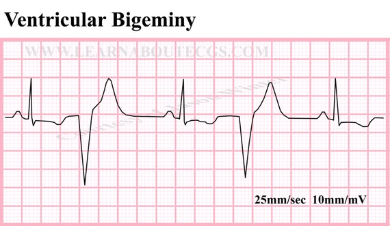 Items similar to Ventricular Bigeminy ECG Strip on Etsy