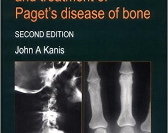 PATHOPHYSIOLOGY and Treatment of Paget's Disease of Bone (2nd Revised edition) by John A Kanis. 1998