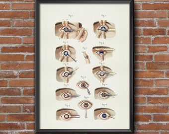 Old vintage Illustrations of Anatomy-Anatomy-medical eye operation Prints