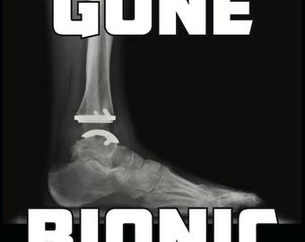 Ankle Replacement - Gone Bionic Afinity