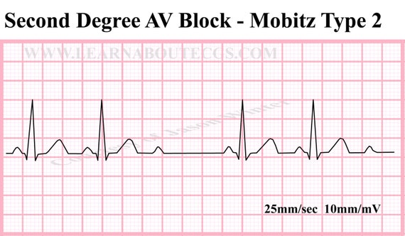 items-similar-to-second-degree-av-block-type-2-ecg-strip-on-etsy