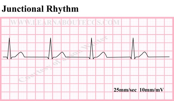 Items similar to Junctional Rhythm ECG Strip on Etsy