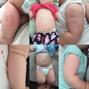 Natural Eczema Cream | Eczema Salve for Baby + Adults | Relief for Dry Skin | Healing Salve for Eczema Relief | Eczema Lotion| Mother's Day