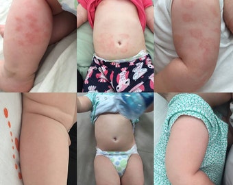 Natural Eczema Cream | Eczema Salve for Baby + Adults | Relief for Dry Skin | Healing Salve for Eczema Relief | Eczema Lotion| Mother's Day